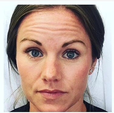 28 yo Botox; Dallas, TX Before