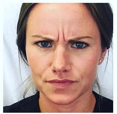 28 yo Botox; Dallas, TX Before
