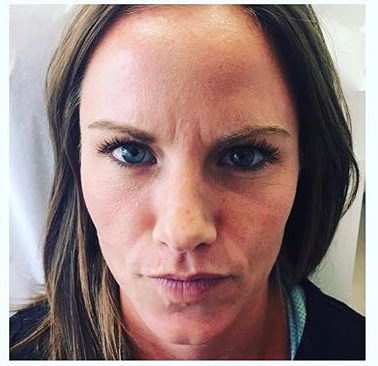 28 yo Botox; Dallas, TX After