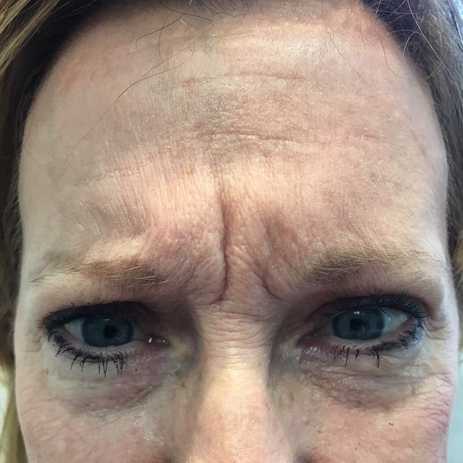 62yo female First Botox Before