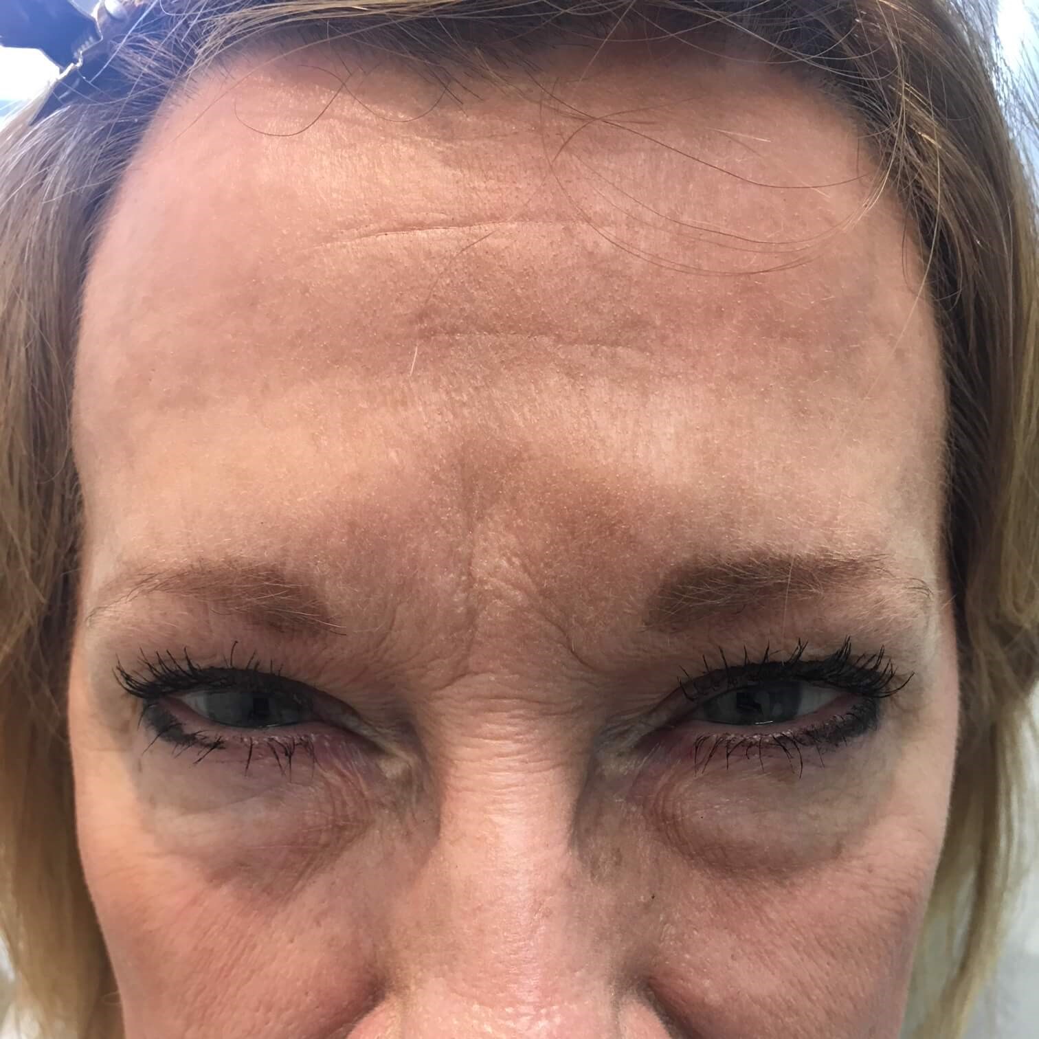 62yo female First Botox After