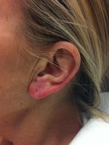 Earlobe Rejuvenation After