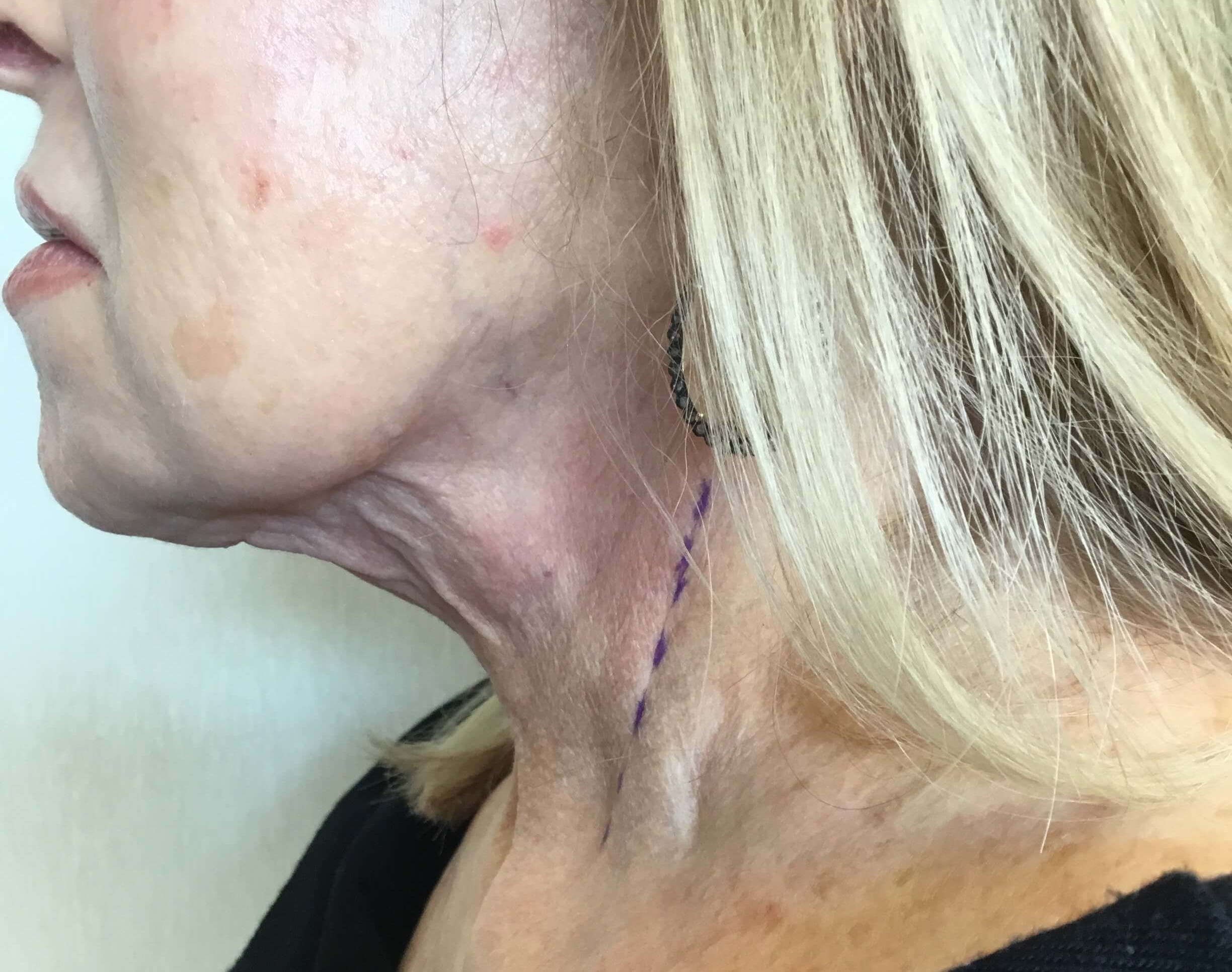Direct Necklift Before