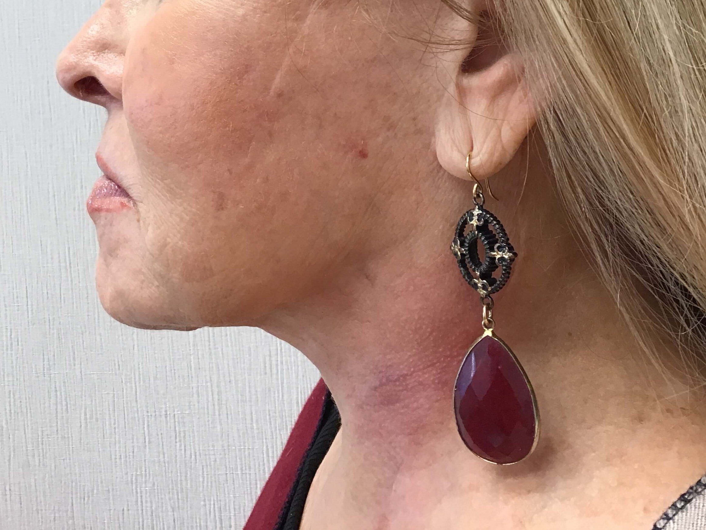 Direct Necklift After