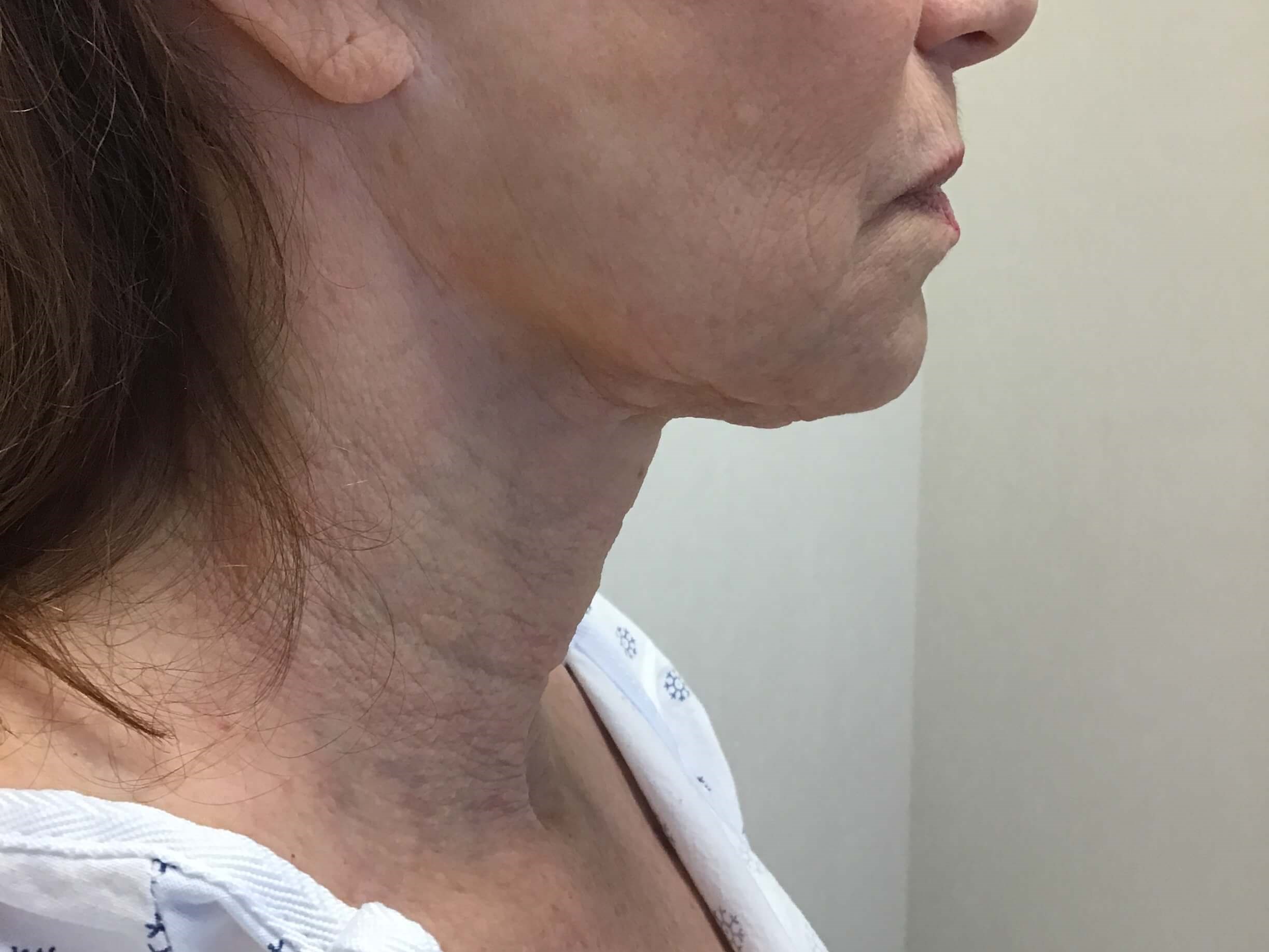 Subtle but Simple Neck Lift Before