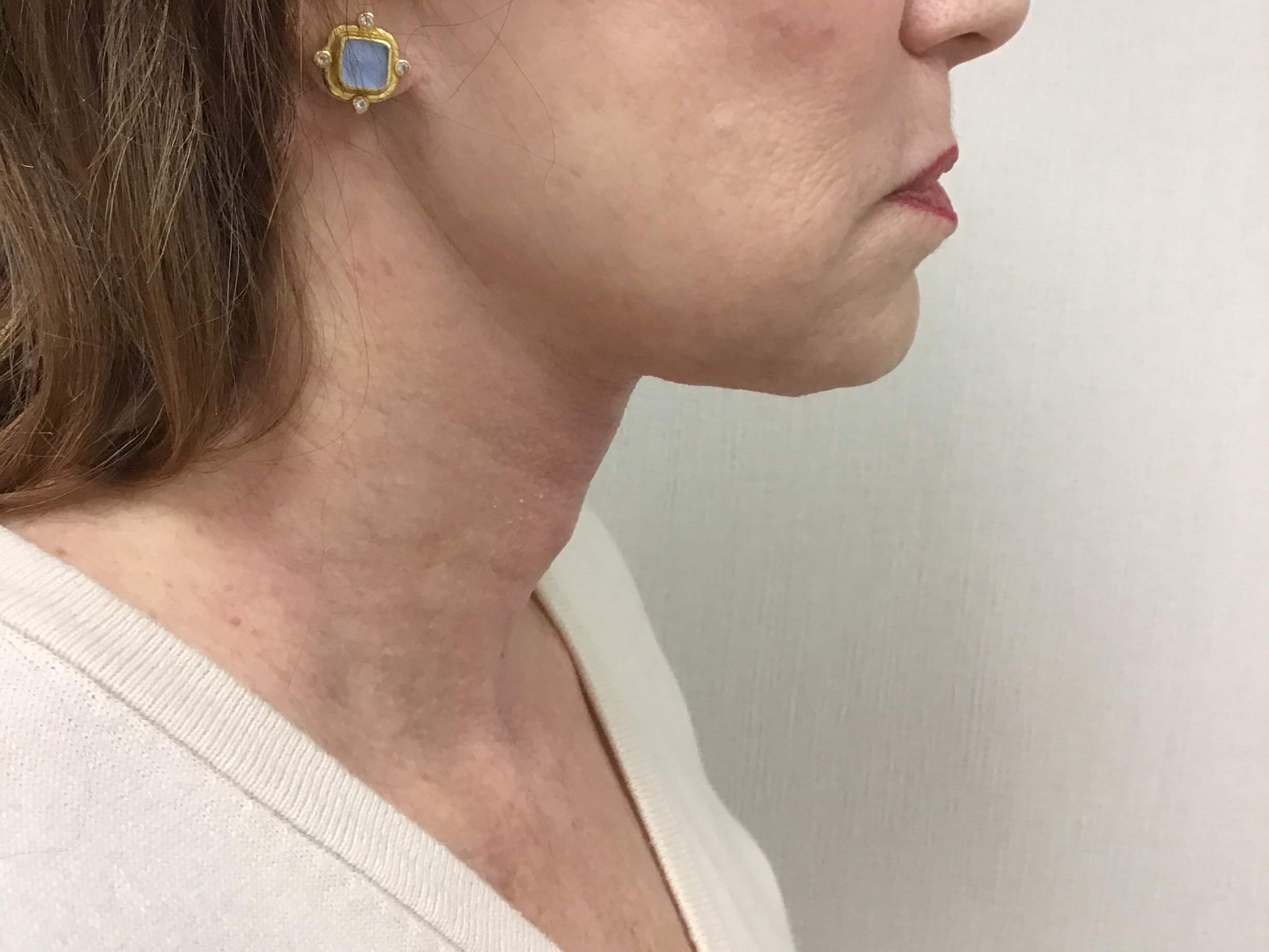 Subtle but Simple Neck Lift After