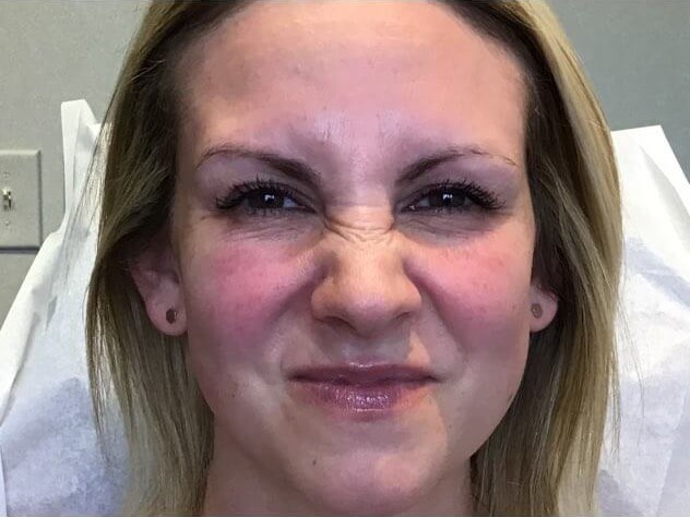 35 is the New 25 with Botox Before