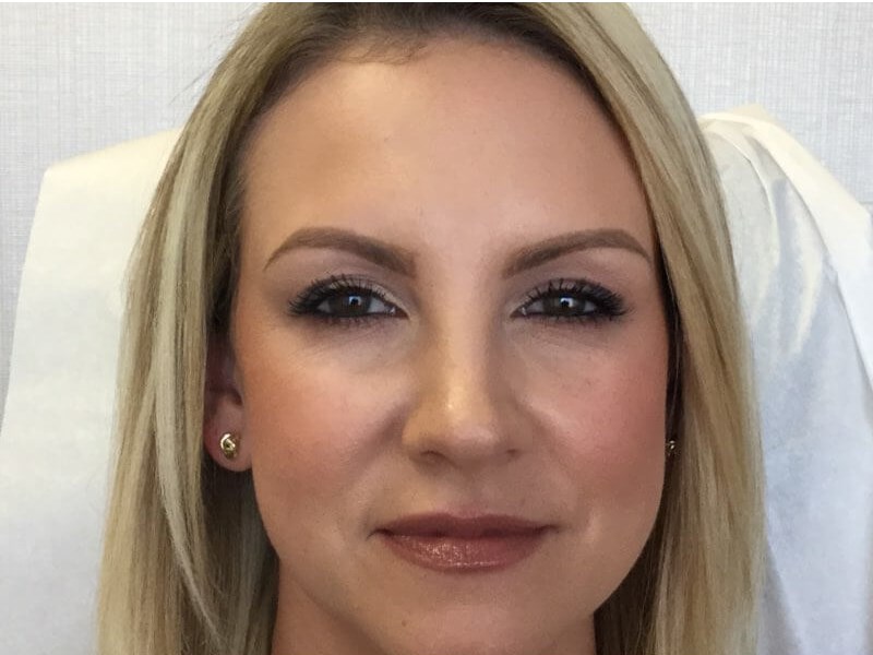 35 is the New 25 with Botox After