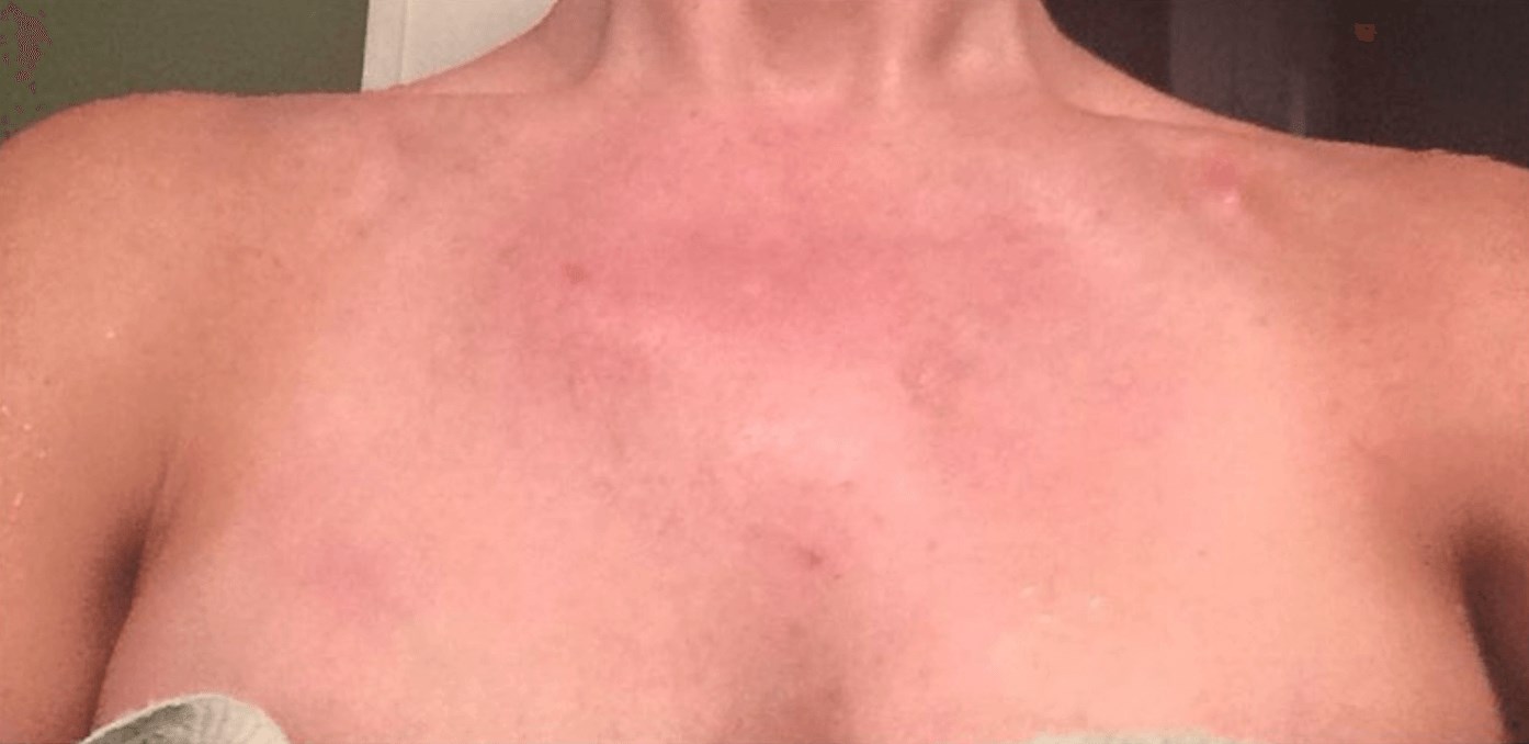 Sciton BBL Photofacial After
