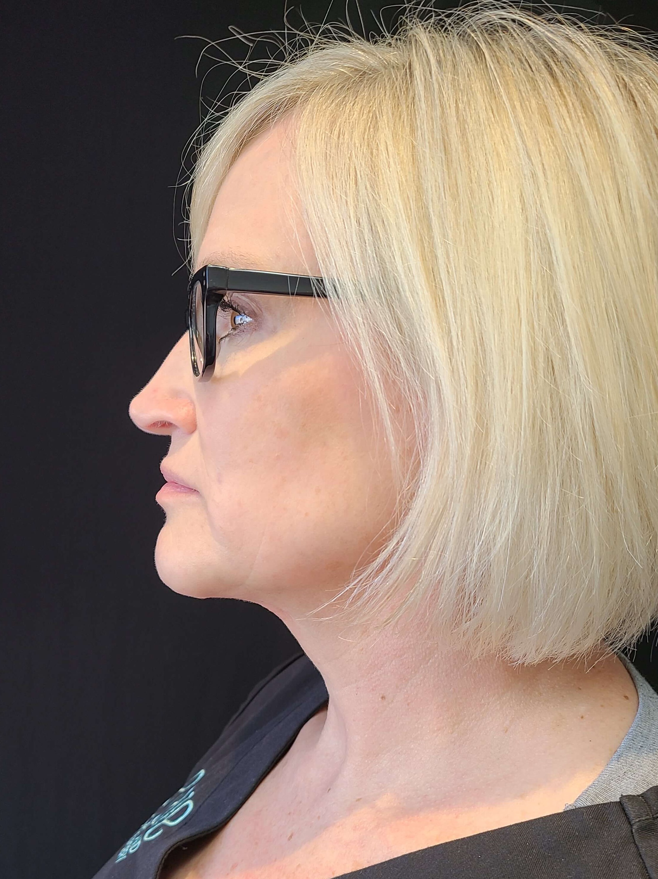 Silhouette and Mini Neck Lift After